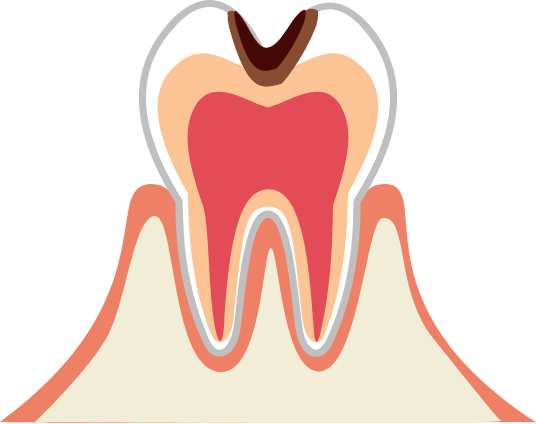 虫歯の断面図