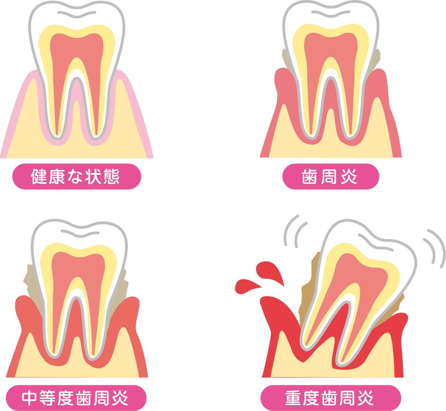 歯周病進行の流れ