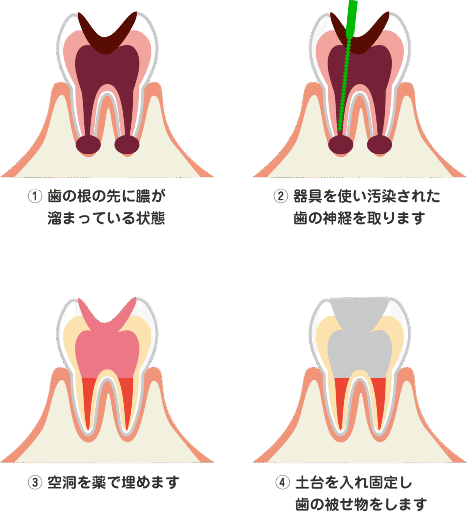 根幹治療の流れ