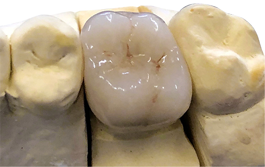 オールセラミッククラウン