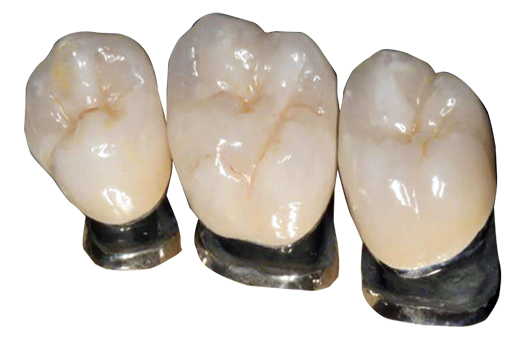 メタルセラミッククラウン