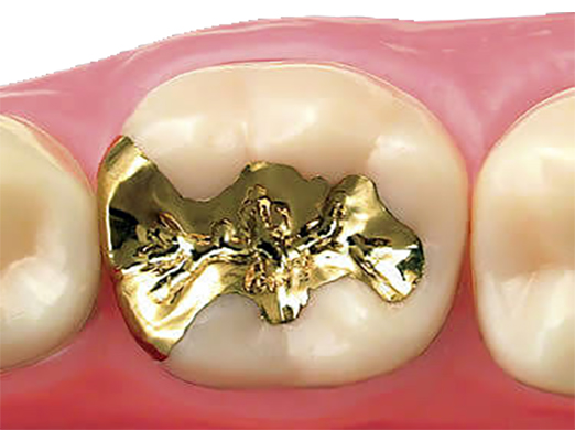 ゴールドインレー