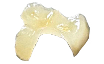 セラミックインレー(e-maxインレー）