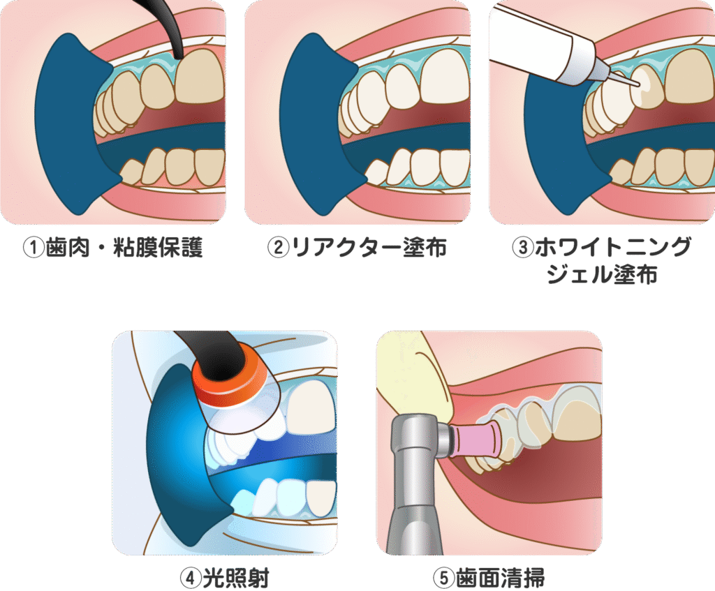 デュアルホワイトニング施術の流れ