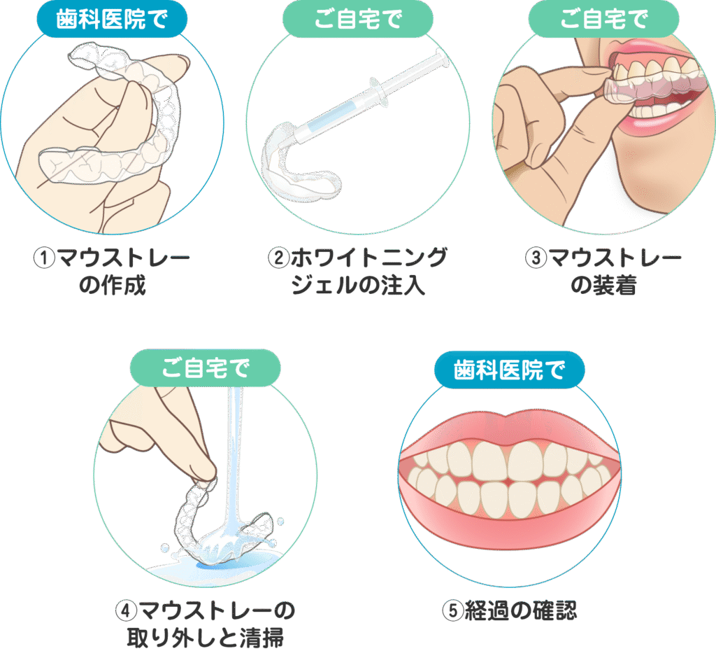 ホームホワイトニングの流れ